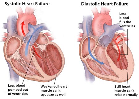 Congestive heart failure: About, Causes, Symptoms, Preventive Measures