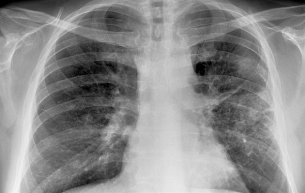 Here's what you need to know about pneumonia, its causes and treatment procedures